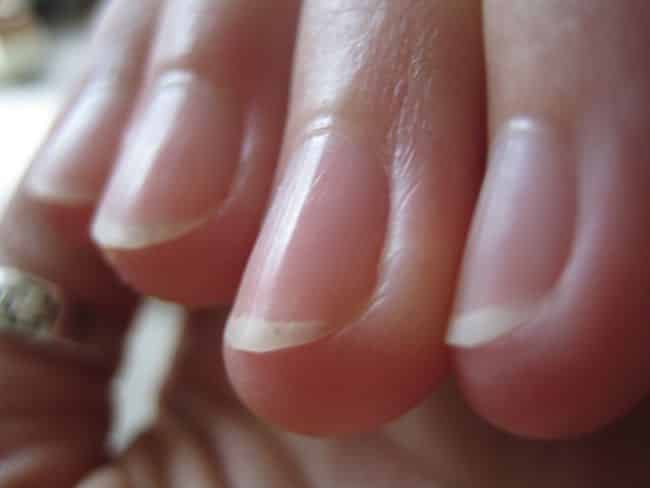 malattie unghie